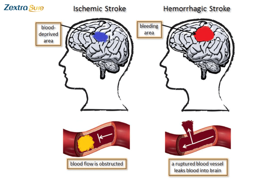 Ischemic stroke vs hemorrhagic stroke